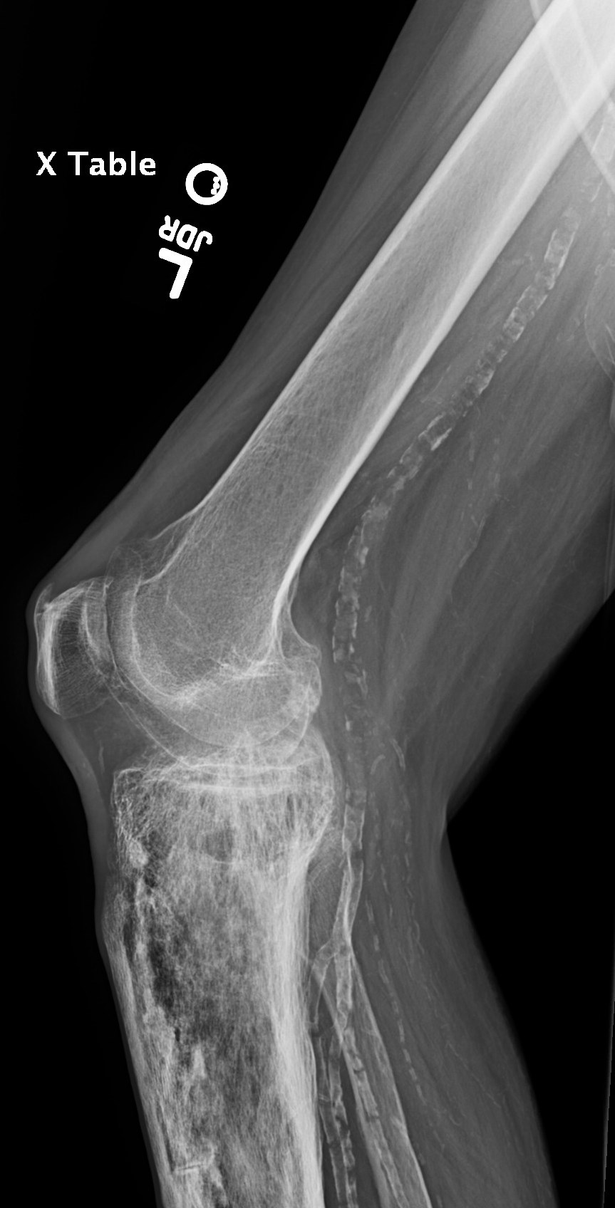 Figure 4 for case Pagets disease ( RID3815 )